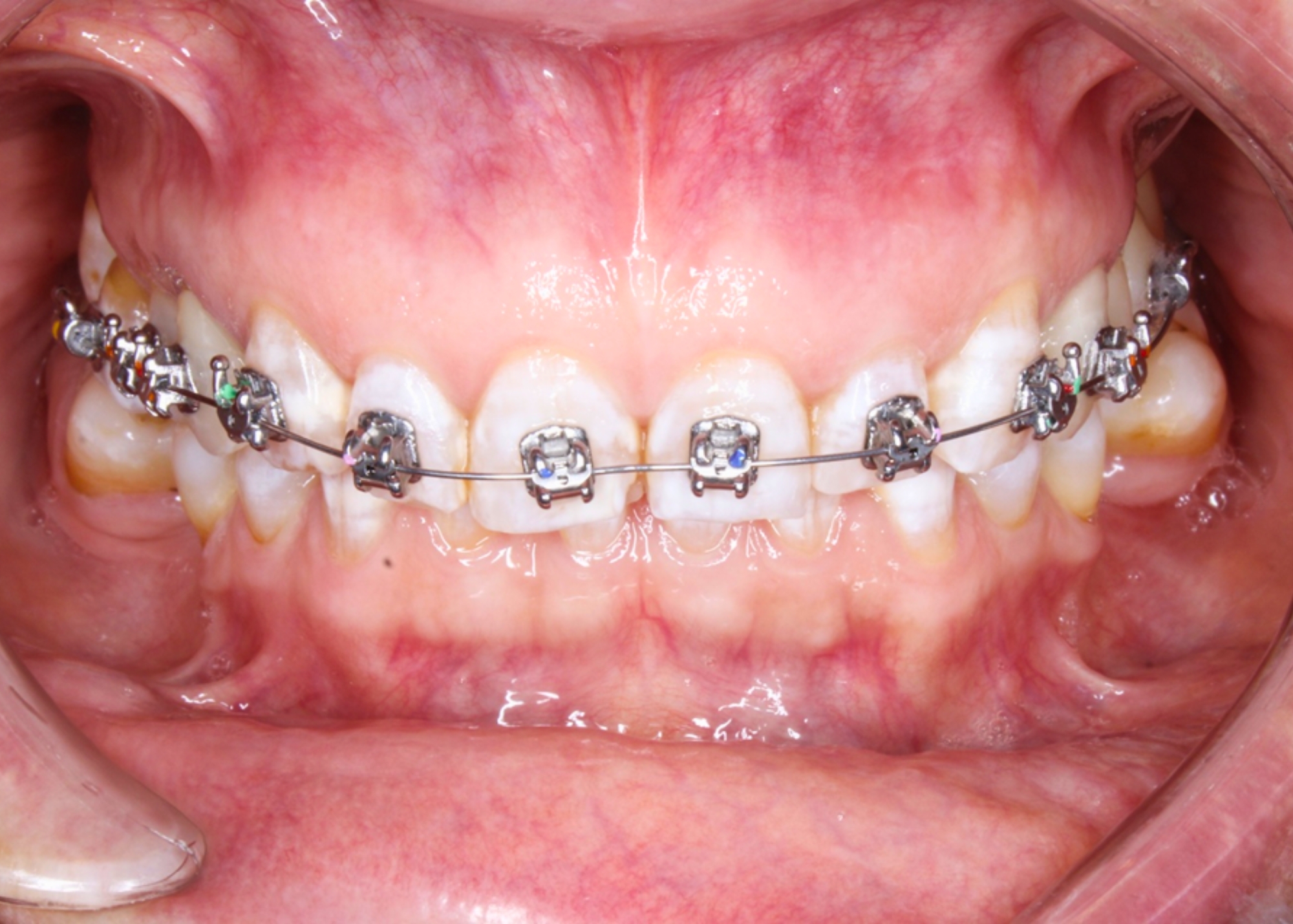 Brackets Autoligados